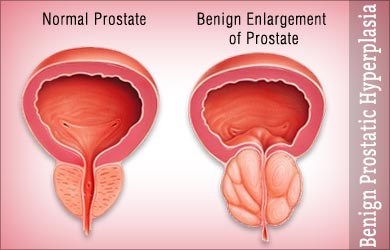 benign-enlargement-of-prostate
