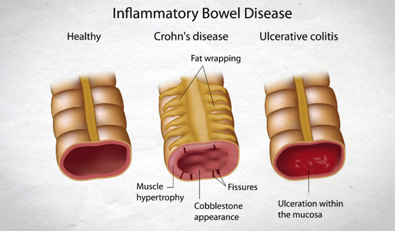 risk_inflammatory_bowel_disease_770new